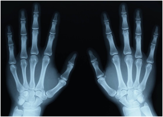 Are X-Rays Dangerous